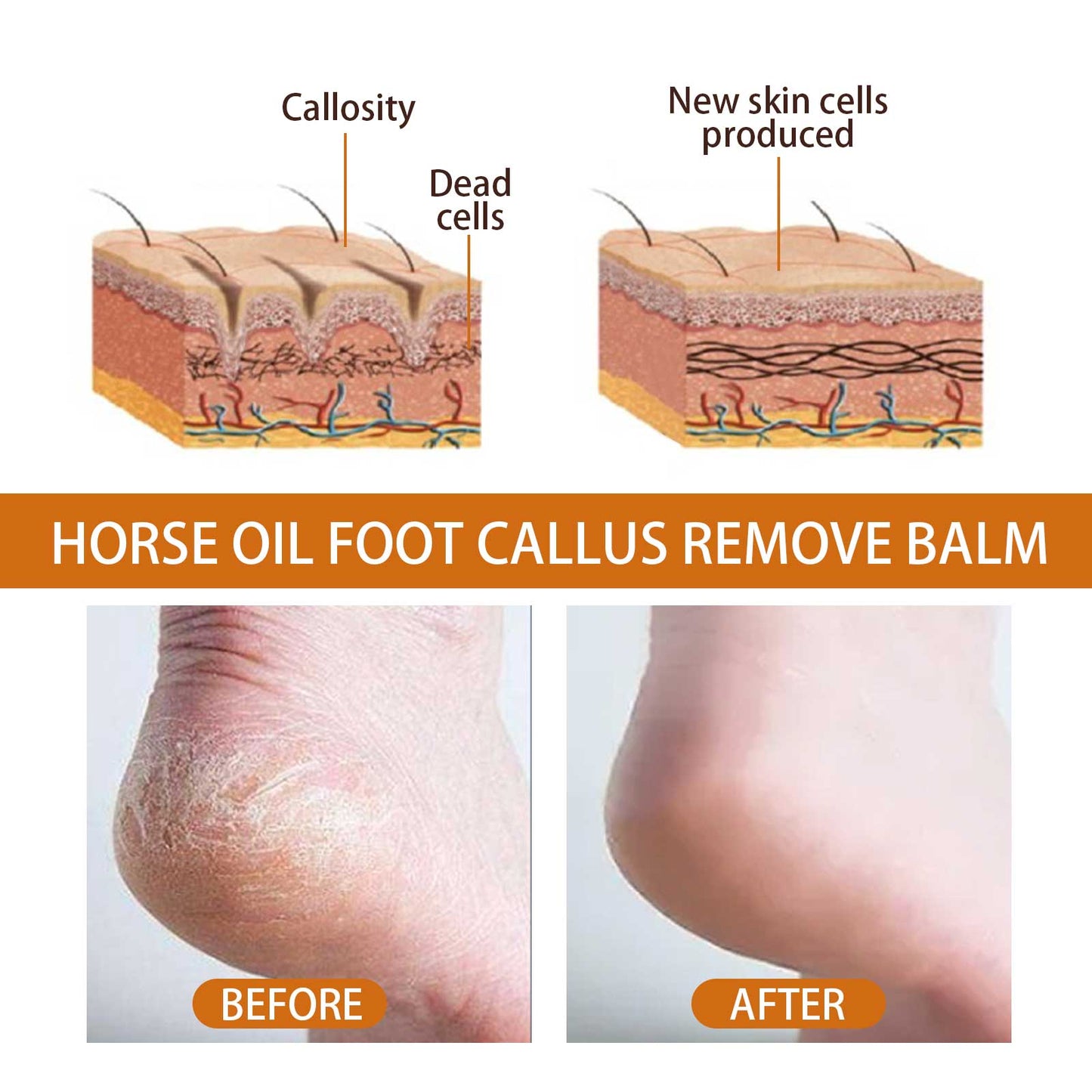 Foot Spray, Exfoliates Prevents Dry Cracking And Repairs Rough Skin Moisturizing Treatment Spray