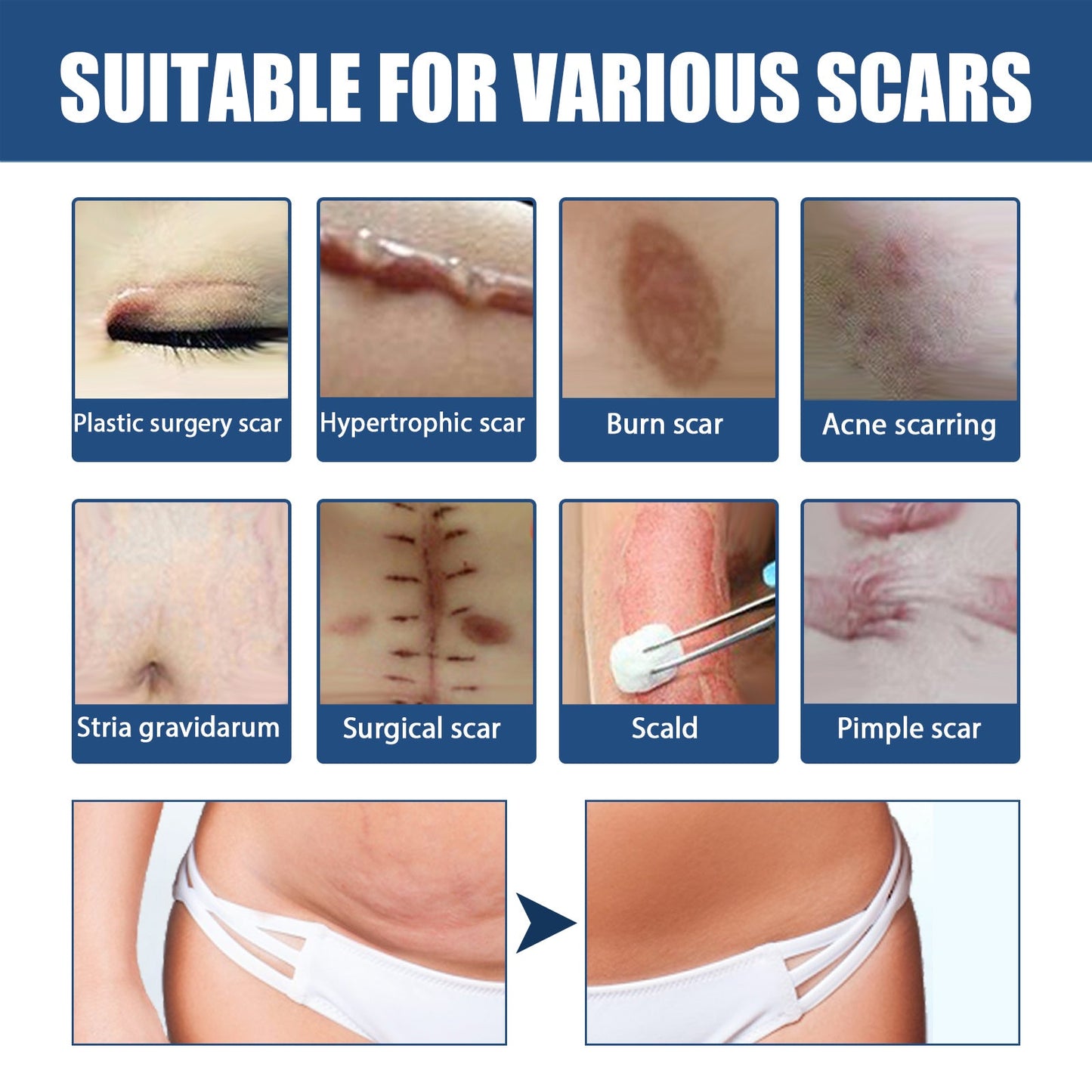 Scar Balm, Surgery Scar Repair Cold Compress Scar Skin Scar Gel Balm