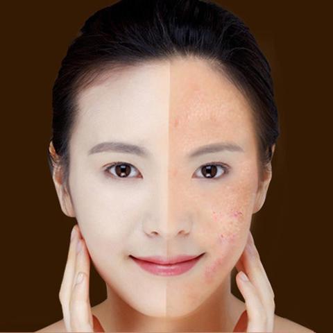 MOQ1  Wrinkle Blemish Pore Acne Scar Remover Pen